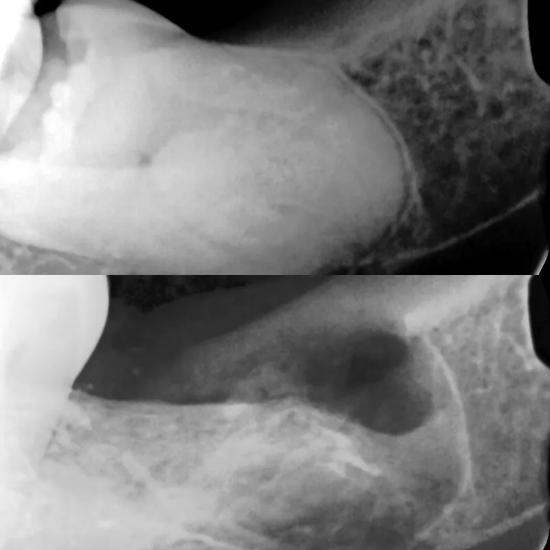 Impacted Wisdom Tooth before and after — Smile Hub Clinics, Johar Town, Lahore