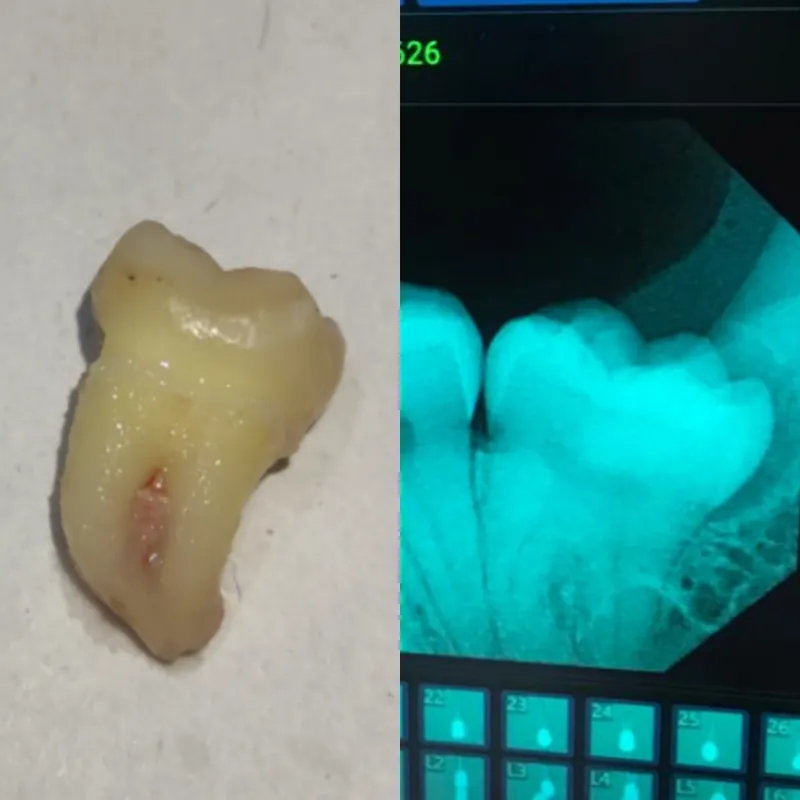 Wisdom Tooth Removal before and after — Smile Hub Clinics, Johar Town, Lahore